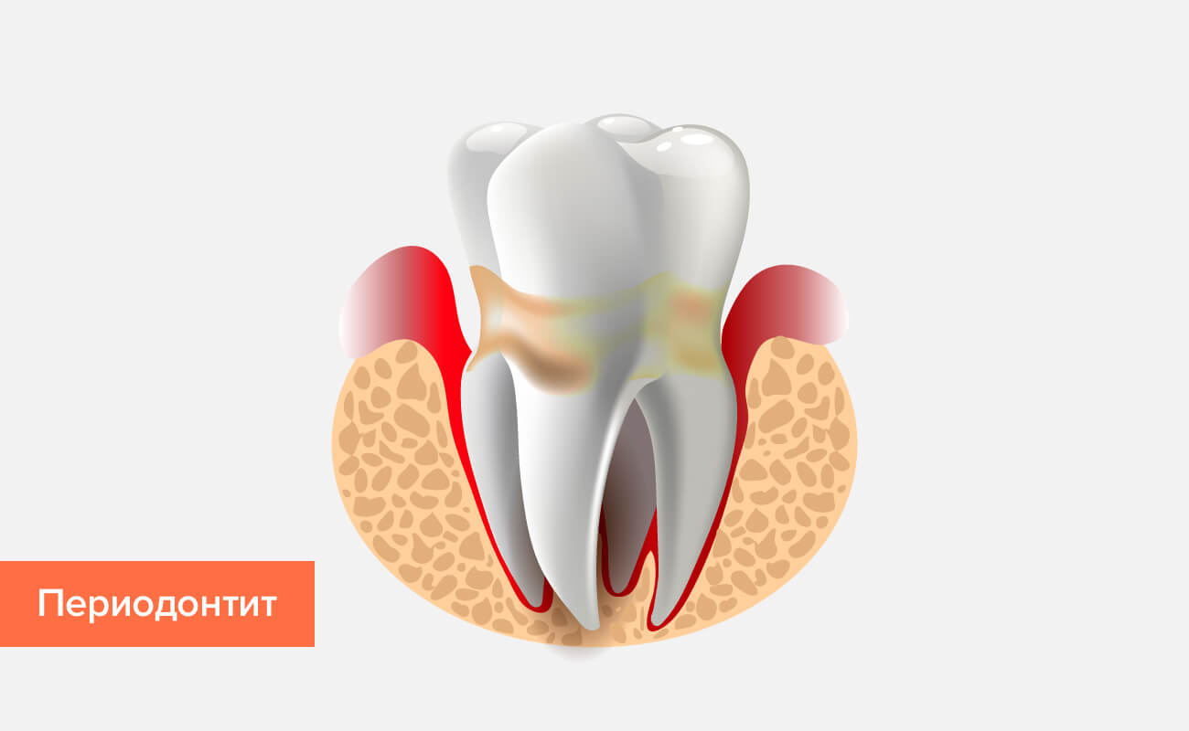 Периодонтит зуба мудрости симптомы и лечение thumbnail