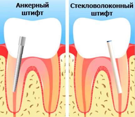 Zub na shtifte - cena za odin zub- ustanovka i vidi 2