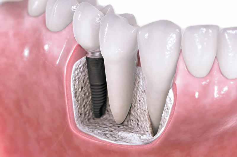 implant