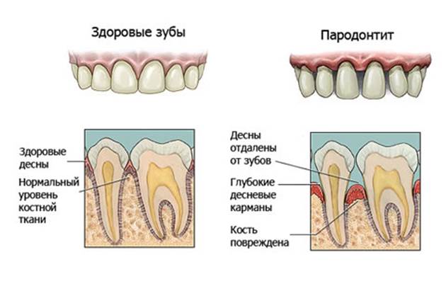 parodontit11