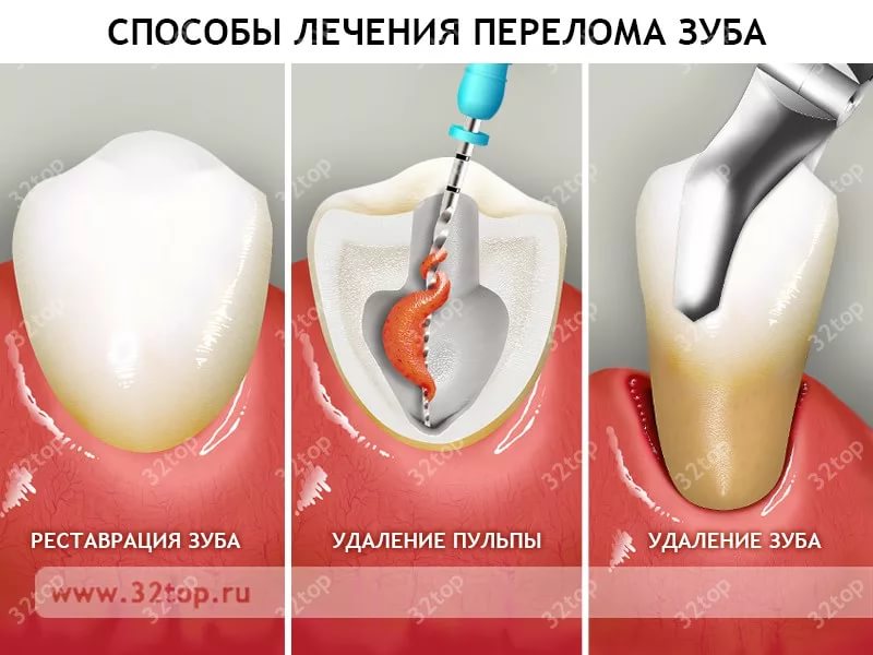 Сломался молочный зуб у ребенка