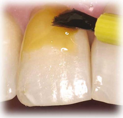 Покрытие зуба защитным лаком Томск Радищева Отбеливание зубов Opalescence Томск Строевая