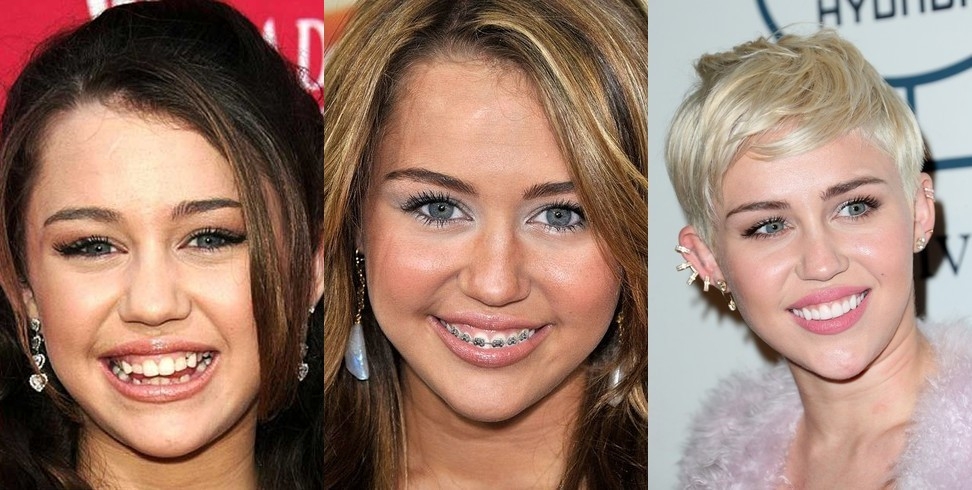 1431584856 dentalbraces15