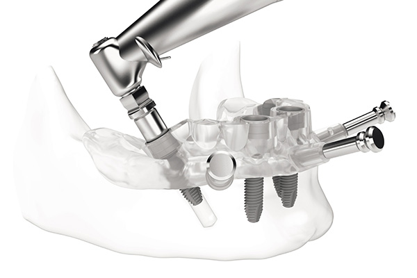 3D-Dental-Implants-2