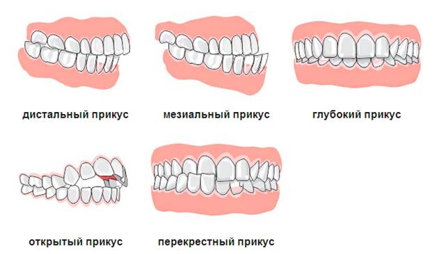 Выровнять прикус зубов Импланты XIVE Томск Правобережная