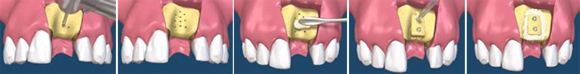 Narashchivaniye obyema -alveolyarnogo grebnya