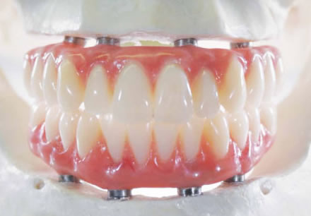 all-on4-cosmetic-dentistry-757dentalcom