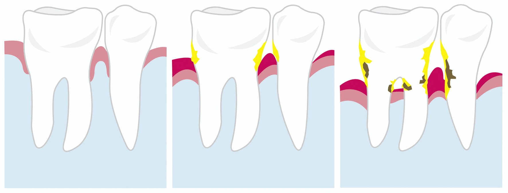 entwicklung der parodontitis neu