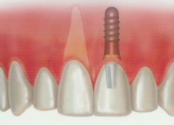 implant perednego zuba