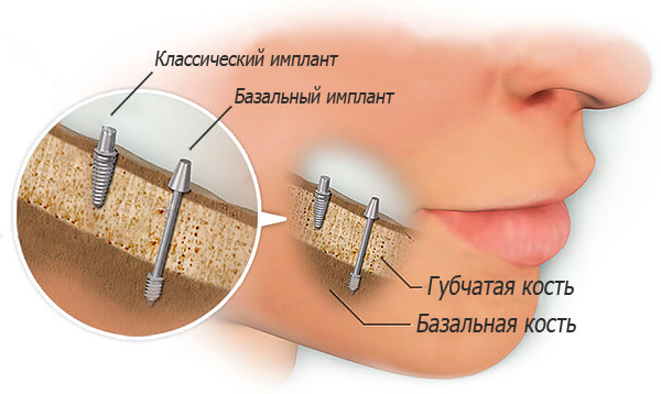 implantaciya-zubov-vidy-i-ceny-19
