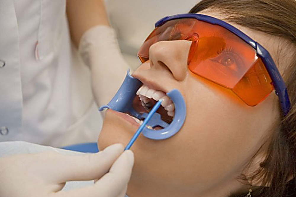 Покрытие зуба защитным лаком Томск Радищева стоматология томск на учебной