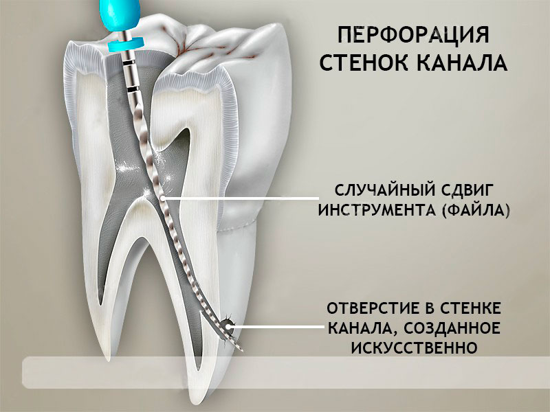perforaciya-kornya-zuba