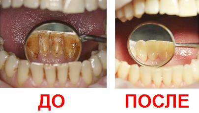 professionalnaja-chistka-zubov