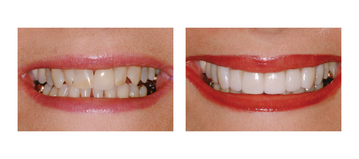 protezirovanie perednih zubov 2 do posle