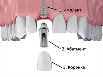 ustanovka-koronki-na-implant