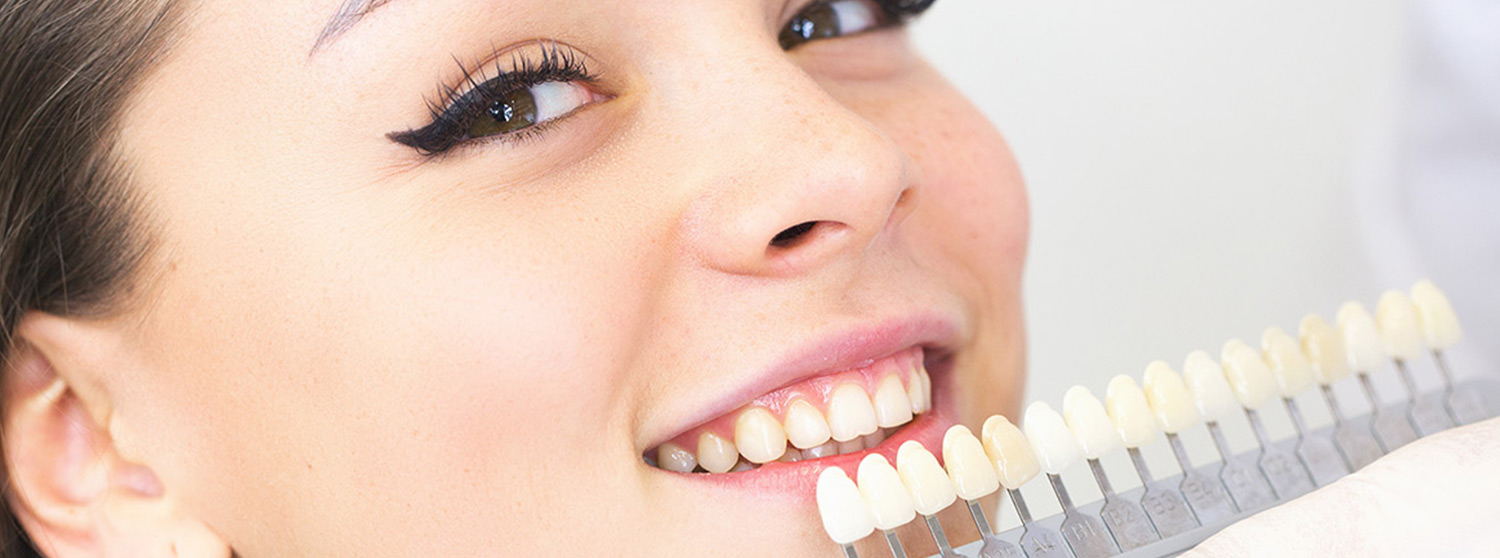 veneers1