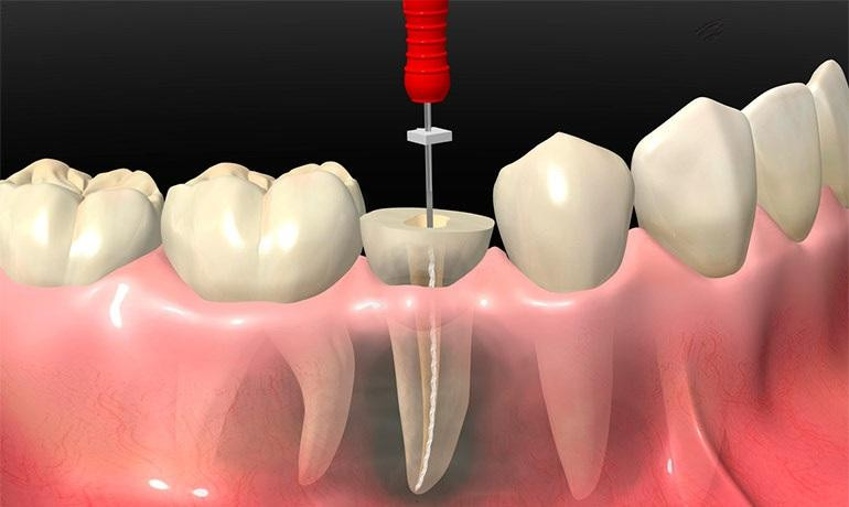 Все, что вы хотели знать про зубные штифты в стоматологии