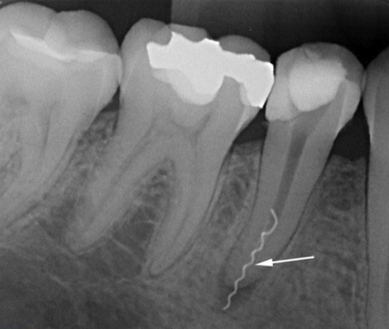 Боль зуба под коронкой