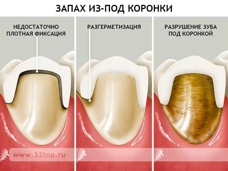 Болит зуб под коронкой, что делать?